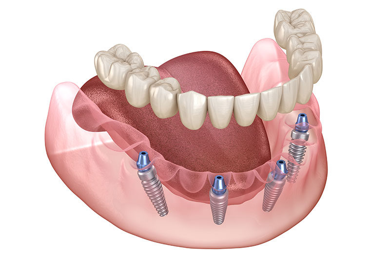 All on 4 Dental Implants in Sicklerville