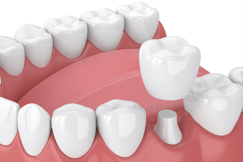 Dental Crowns in Sicklerville
