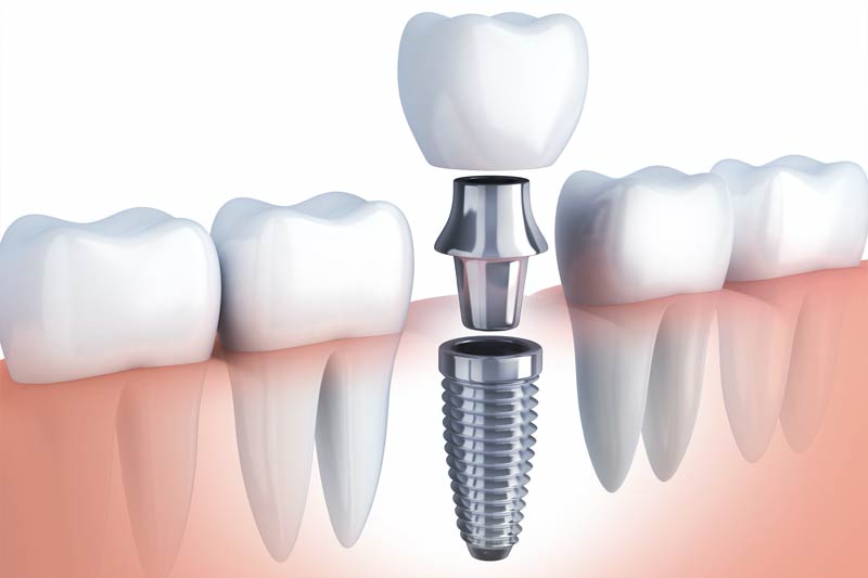 Implants Dentist in Sicklerville