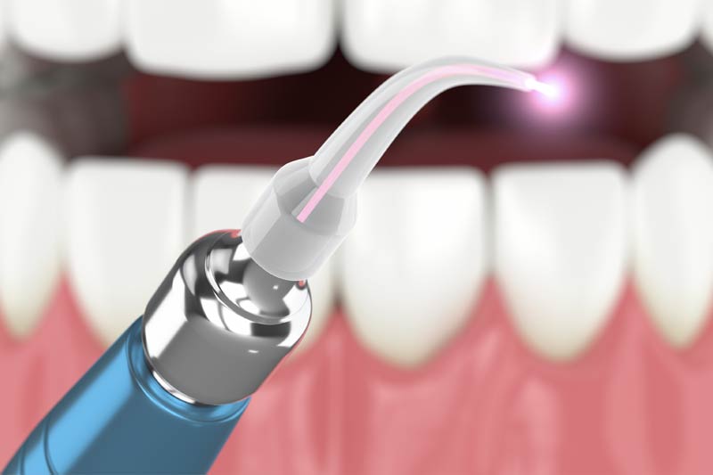 Laser Dentistry in Sicklerville