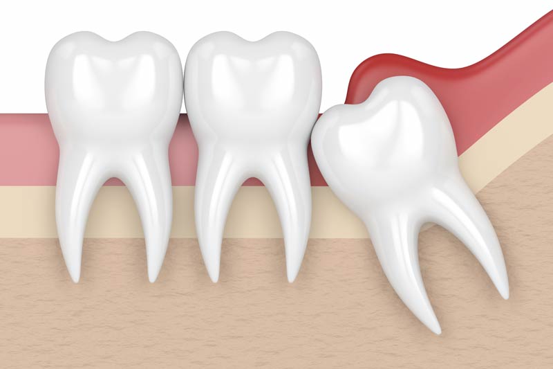 Wisdom Tooth Removal in Sicklerville